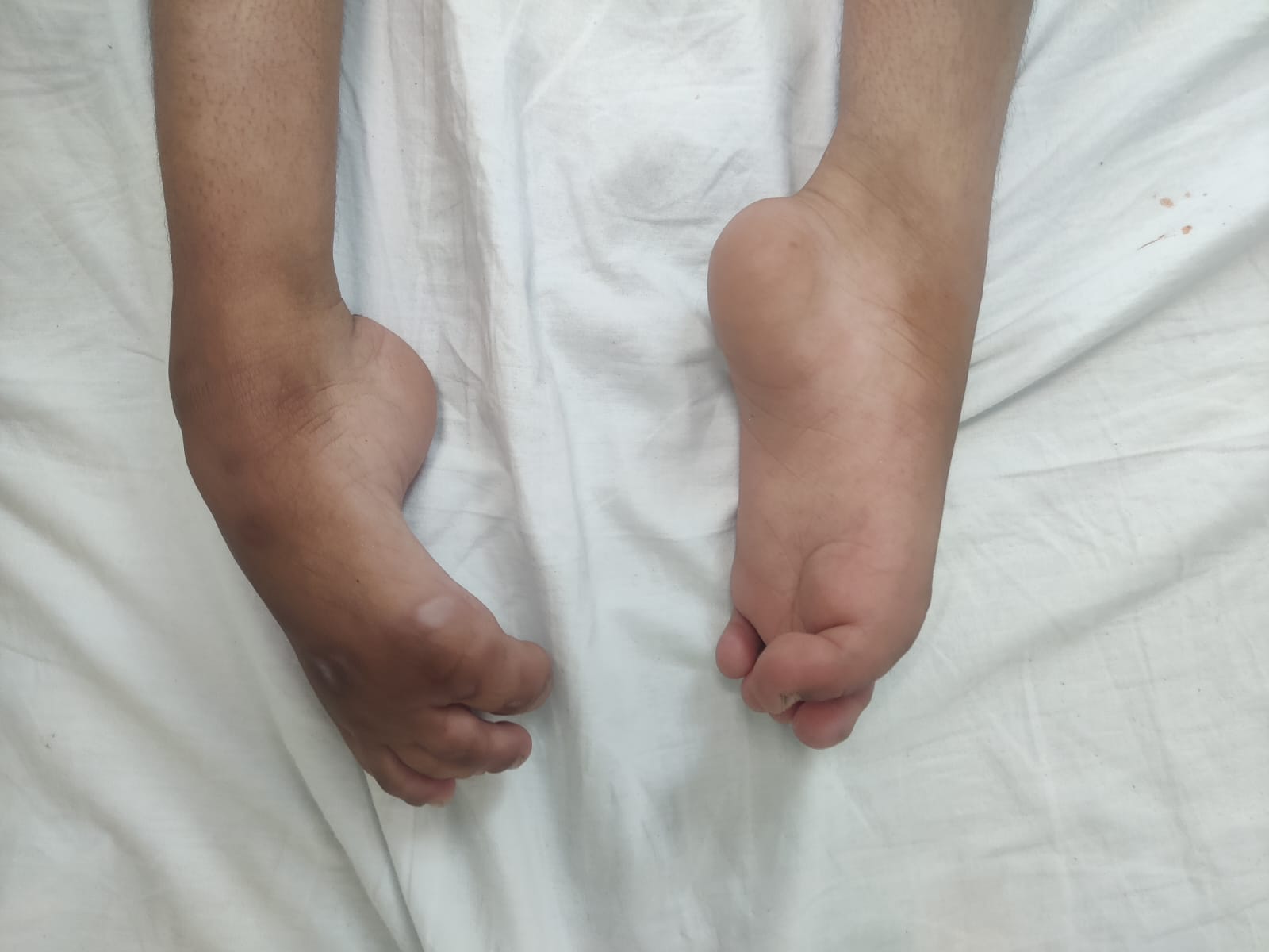 'एम्स जम्मू ने एक युवा मरीज की अभूतपूर्व पुनर्वास सर्जरी करके एक और उपलब्धि हासिल की'